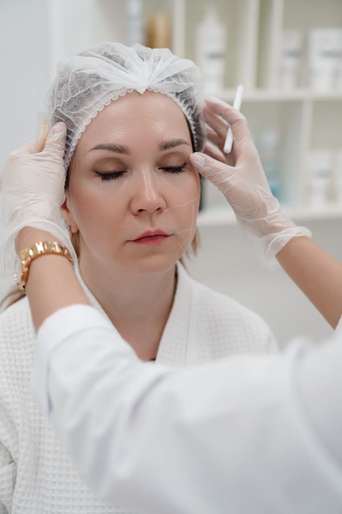 Безоперационная блефаропластика Альтера