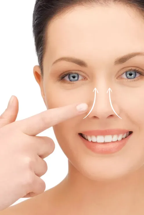 Нитевая ринопластика