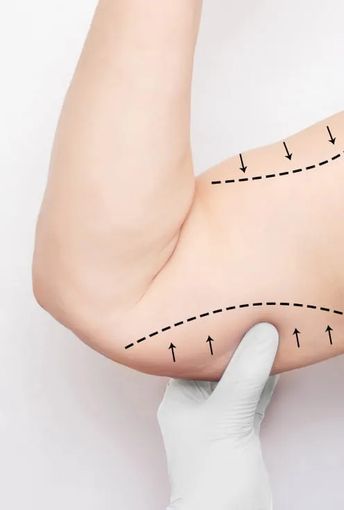 Липосакция рук