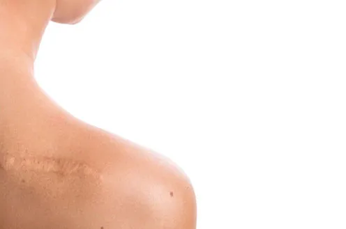 Как избавиться от шрамов и восстановить кожу?