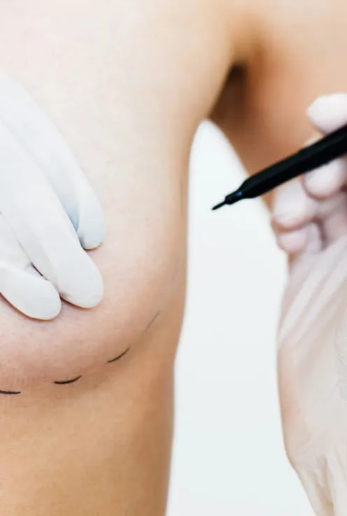 Липофилинг груди