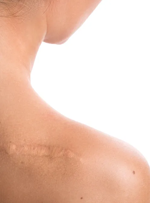 Удаление шрамов и растяжек