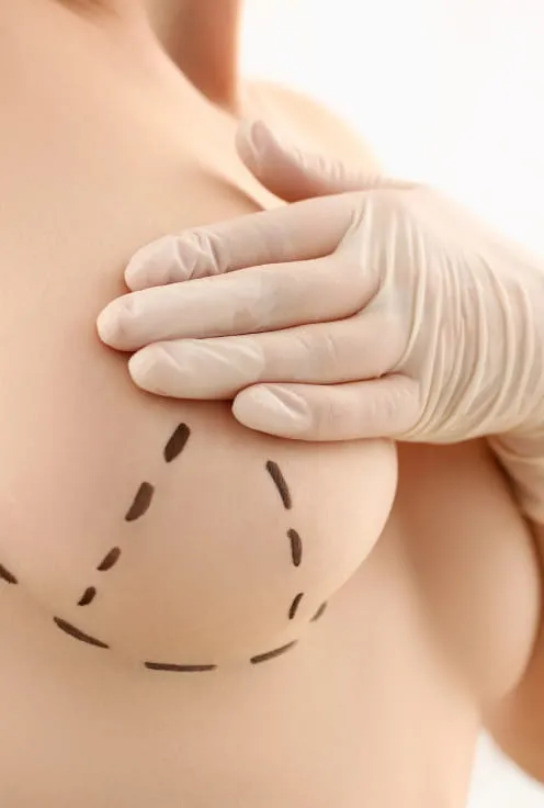 Подтяжка груди (мастопексия)