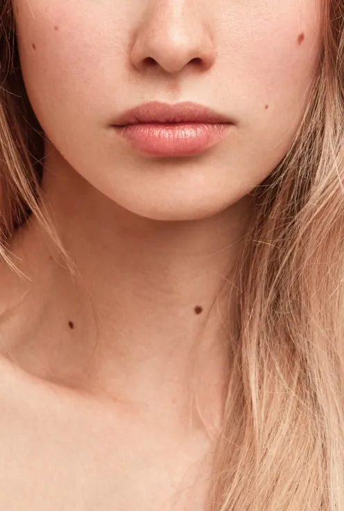 Удаление новообразований кожи