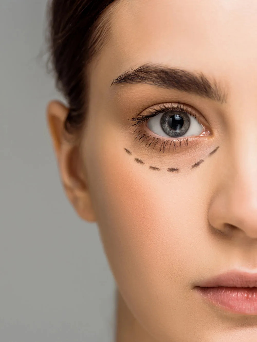 Трансконъюктивальная блефаропластика