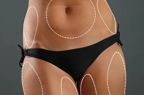 Опасна ли липосакция?