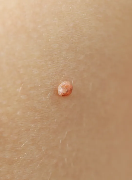 Удаление новообразований кожи на аппарате Фотек