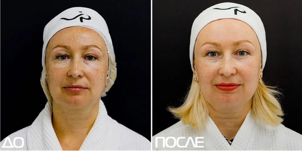 Проект "Скажи пигментации нет"