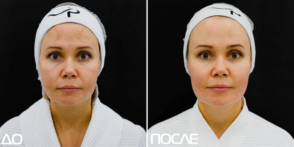 Проект Скажи пигментации нет Проект Скажи пигментации нет