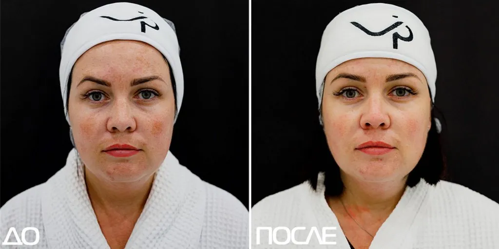 Проект "Скажи пигментации нет"